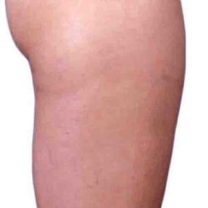 Body Contouring