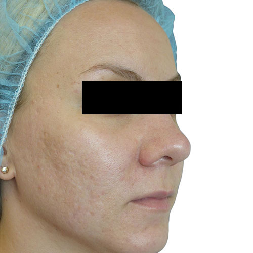 Gregory_antoniak_after