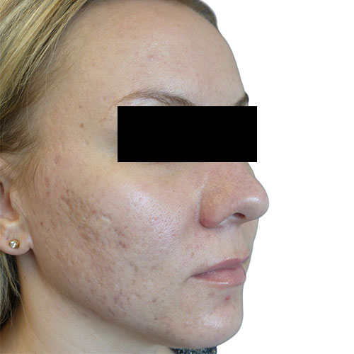 Gregory_antoniak_before