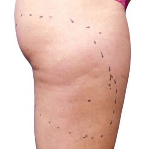 bosy_contouring_before (1)