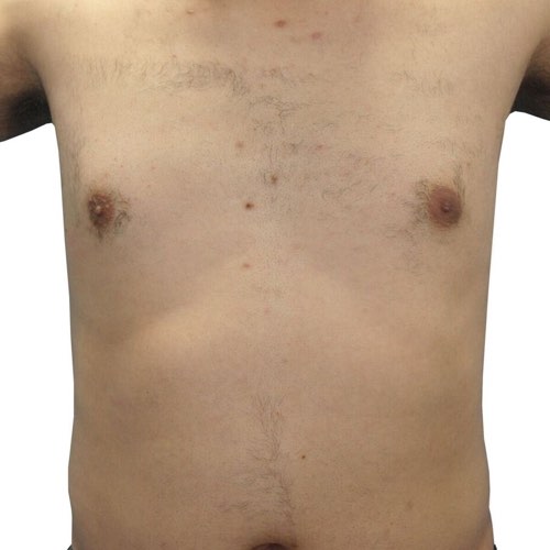 Laser Hair Removal Innisfil