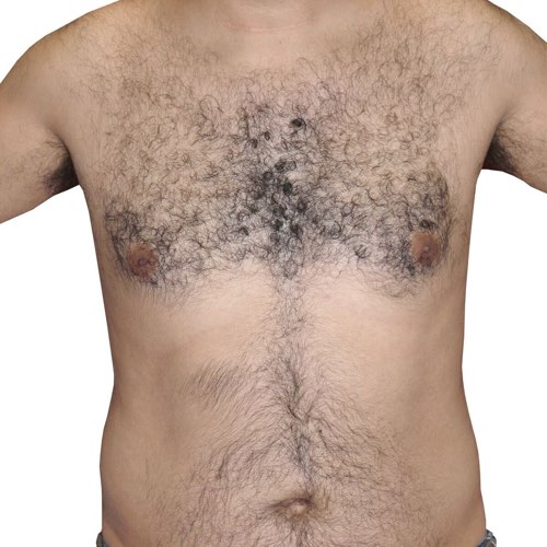 Laser Hair Removal Innisfil